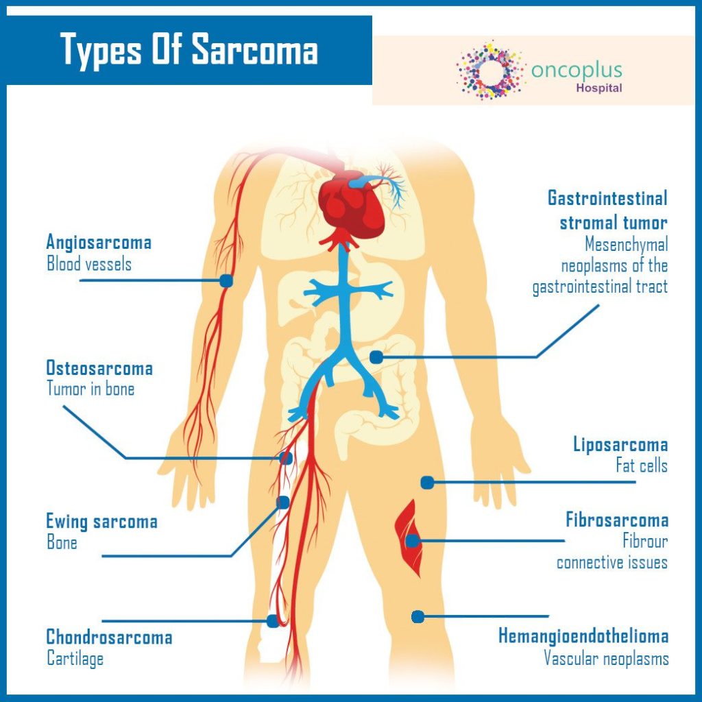 type of sarcoma 1024x1024 - Top 3 common chronic diseases in Malaysia